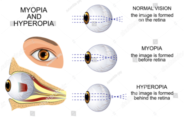 hipermetropia y miopia es lo mismo)